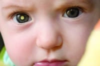 一个学生中有白色“发光”的婴儿，表明可能存在视网膜细胞瘤肿瘤