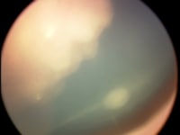 视网膜母细胞瘤肿瘤